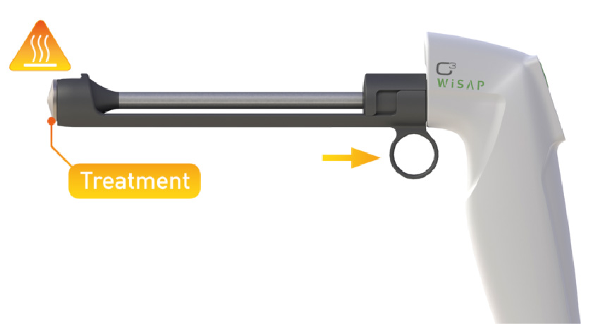Highlighting the ease of use and ergonomics of the heat guard of the Wisp C3 Thermocoagulator