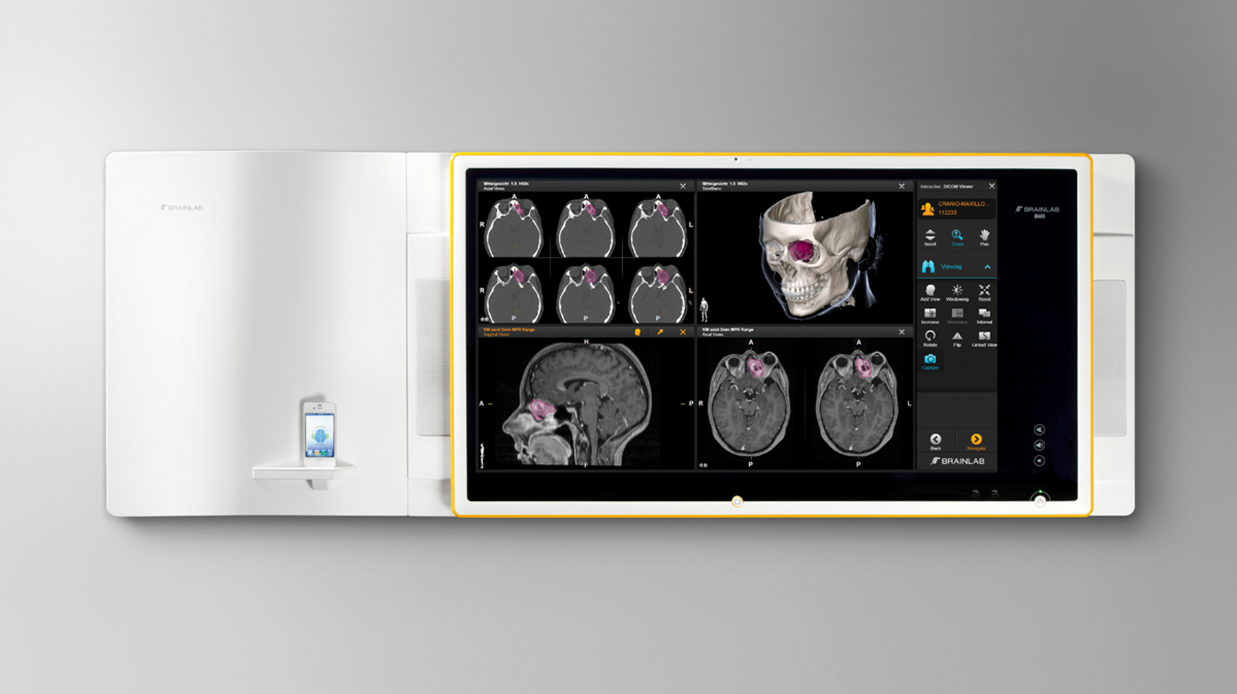 Front View of the Brainlab Buzz OR Monitor displaying interface